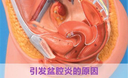 盆腔腹膜炎.jpg