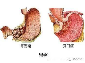 中医认为产生口臭的原因