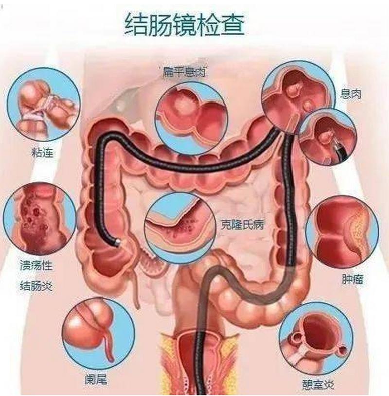 肠胃镜检查怎么做