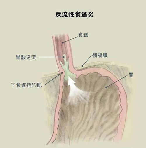 酗酒易患胃窦炎，如果不注意可能导致胃癌