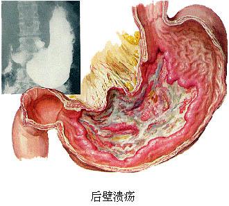 长期口臭的原因是什么？