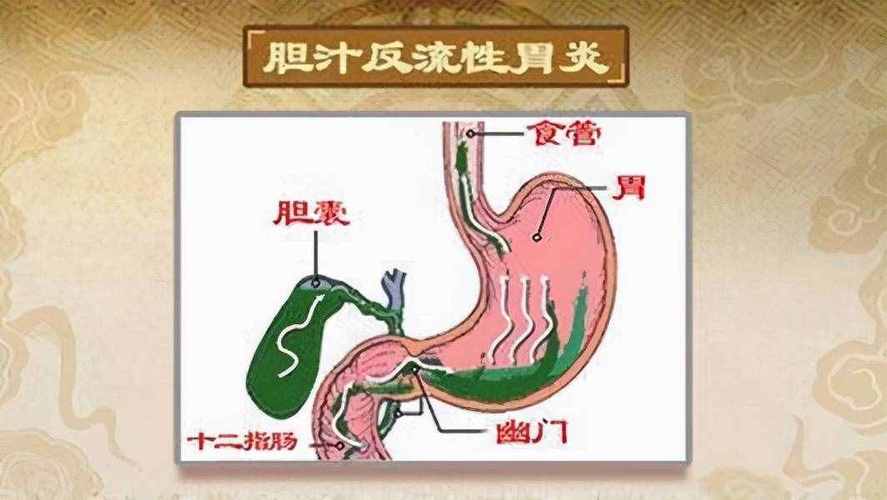 胆汁返流性胃炎的危害