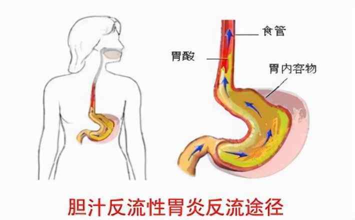 造成胃胀的原因有哪些